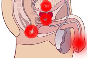 Arrived: chronic prostatitis